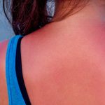 Érythème solaire (allergie au soleil) : comment le traiter ?